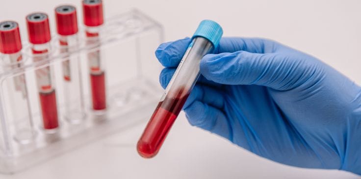 A gloved hand holding a blood sample tube next to more samples on a tray.