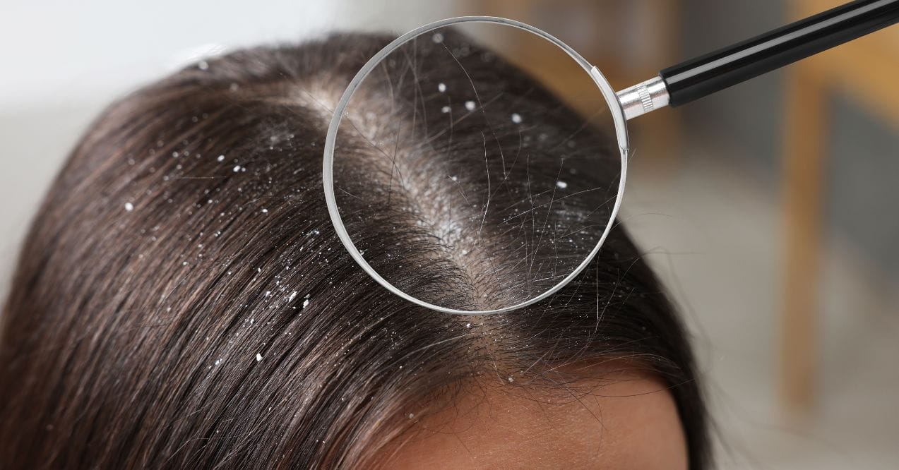 can dandruff cause hair loss?
