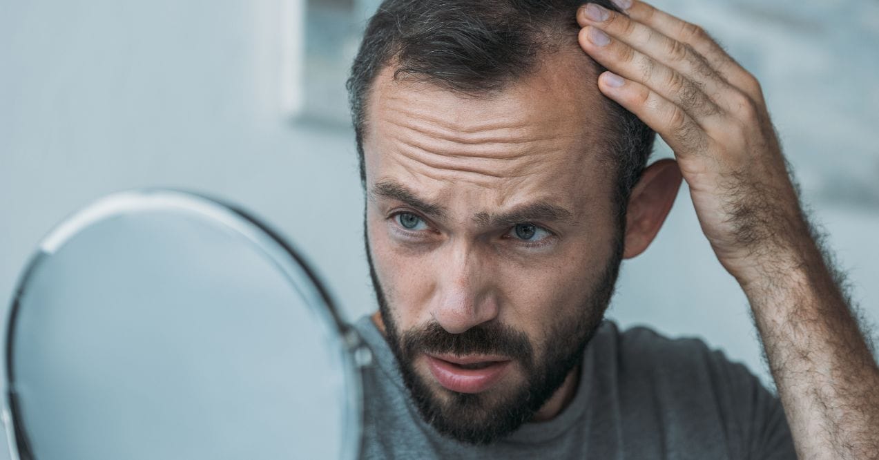 can high testosterone cause hair loss?