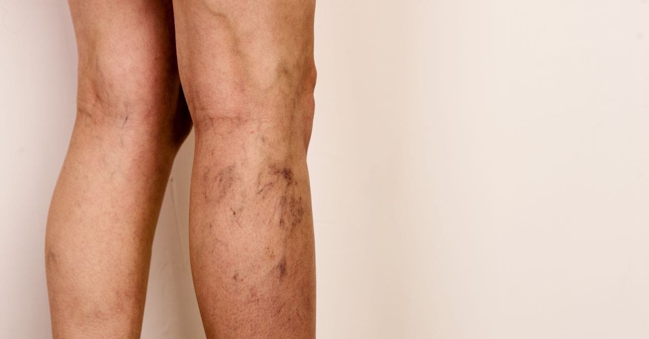 what causes spider veins?