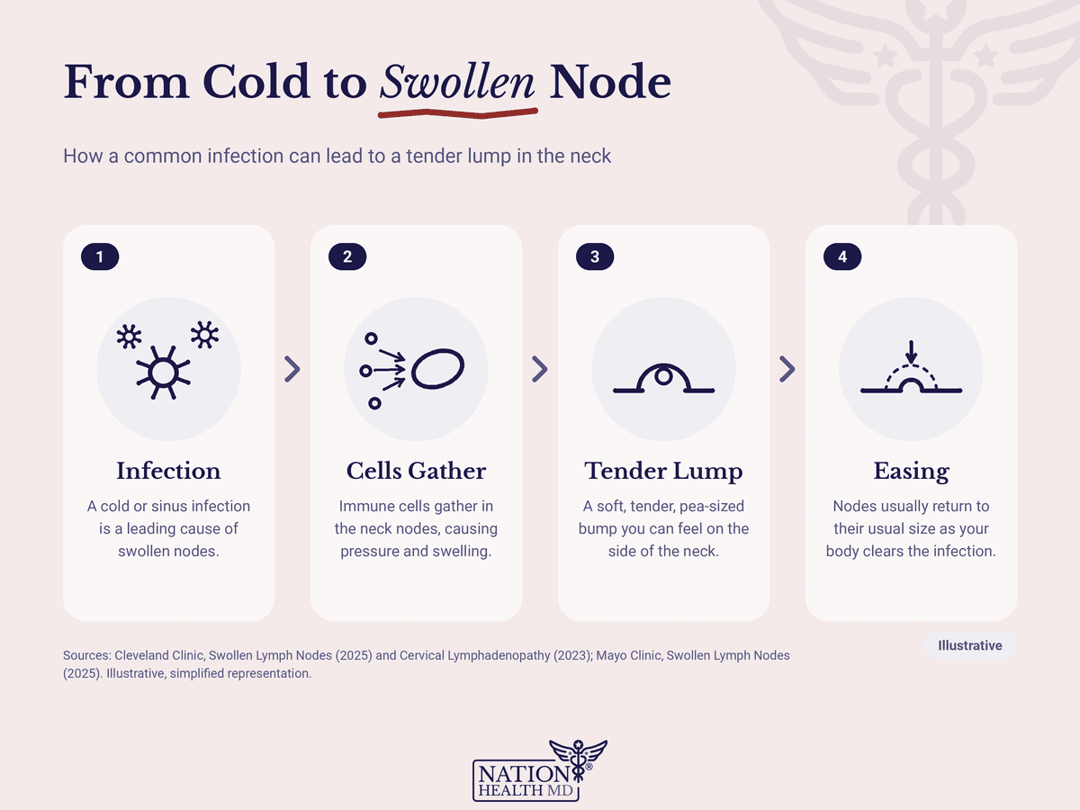 Four stages: a cold or sinus infection, immune cells gathering in neck nodes, a tender pea-sized lump, then easing.